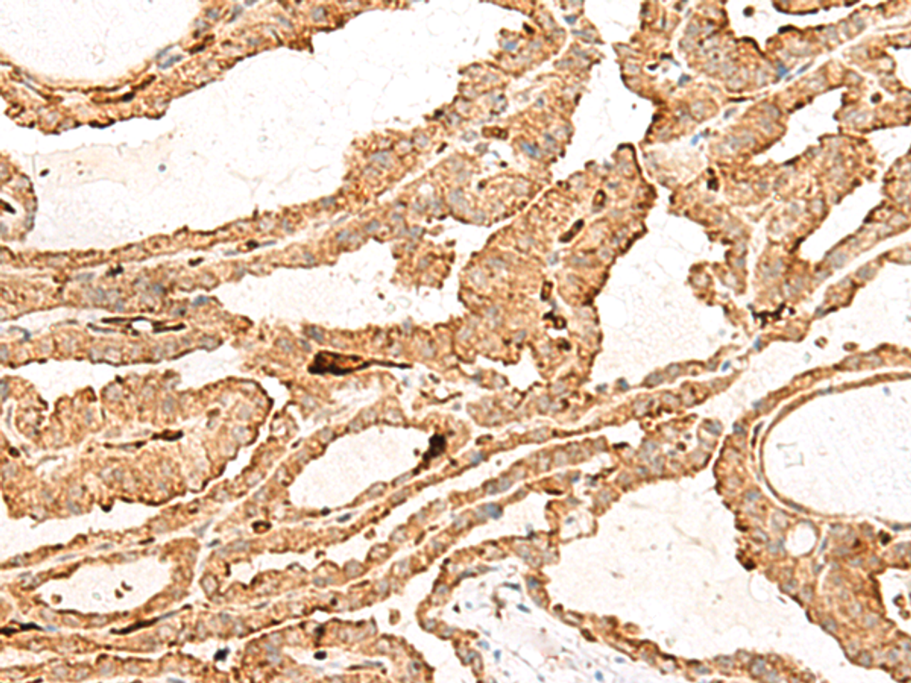 Immunohistochemistry of paraffin-embedded Human thyroid cancer tissue  using HBG1:HBG2 Polyclonal Antibody at dilution of 1:70(×200)
