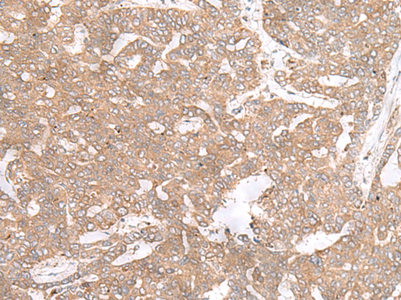 Immunohistochemistry of paraffin-embedded Human liver cancer tissue  using PTP4A3 Polyclonal Antibody at dilution of 1:40(×200)