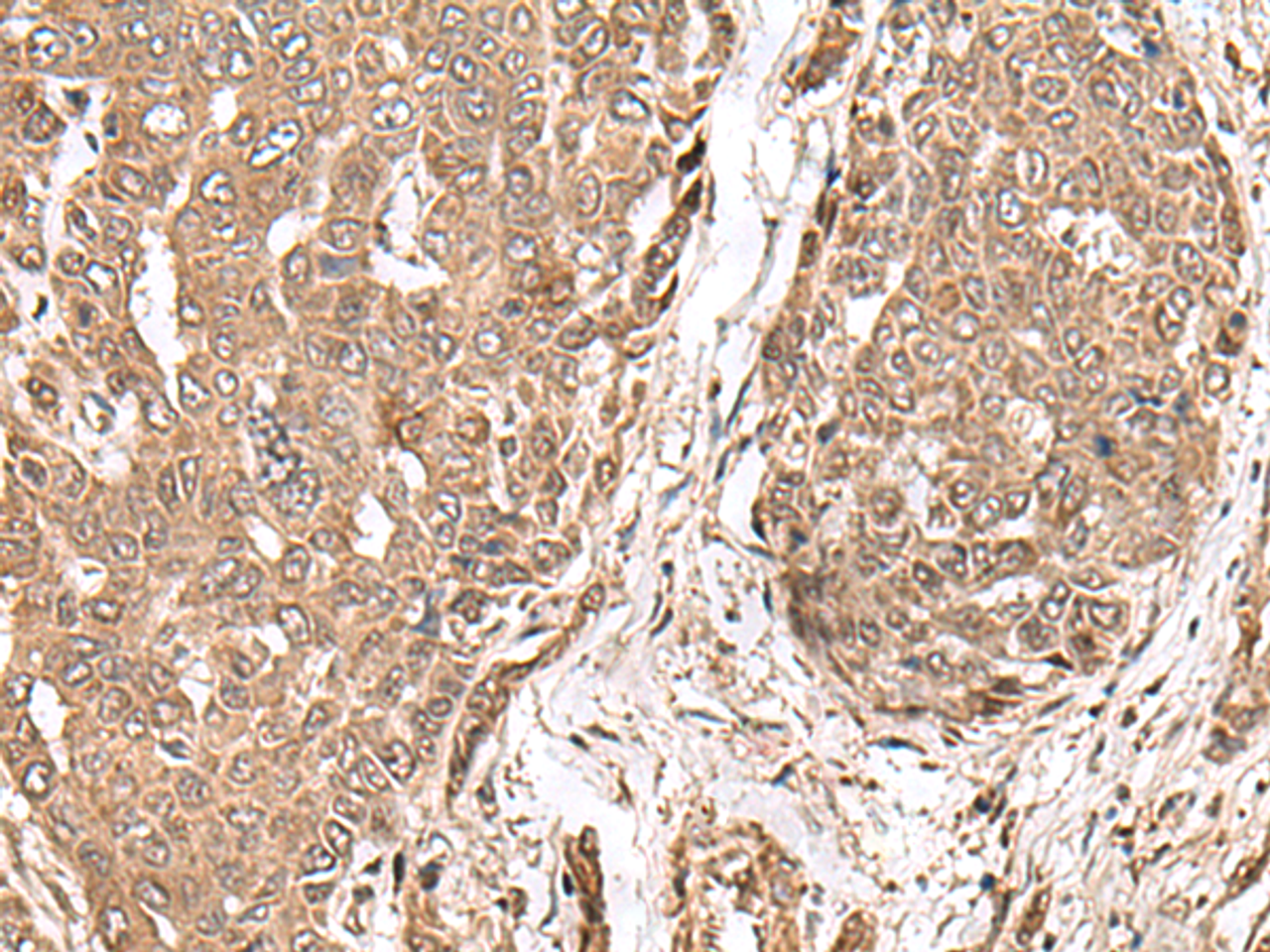 Immunohistochemistry of paraffin-embedded Human liver cancer tissue  using MAGOHB Polyclonal Antibody at dilution of 1:70(×200)