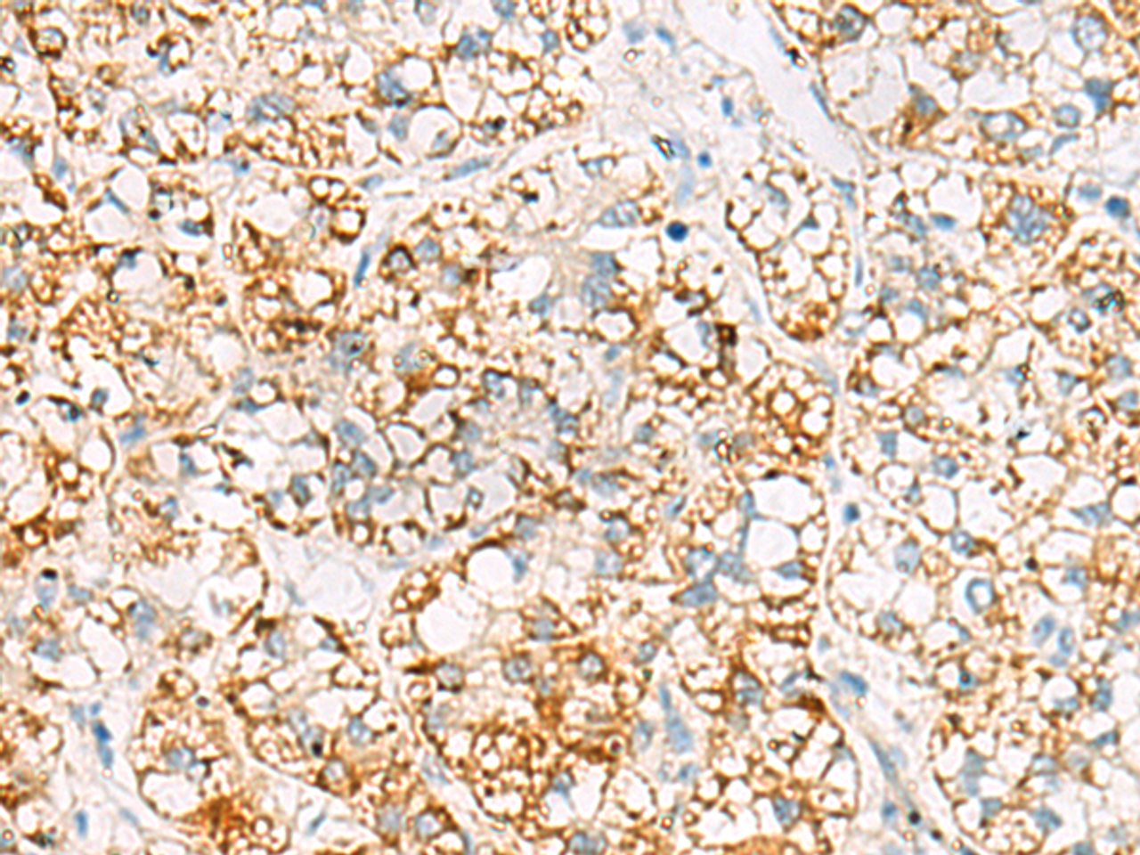 Immunohistochemistry of paraffin-embedded Human liver cancer tissue  using MRPL20 Polyclonal Antibody at dilution of 1:60(×200)