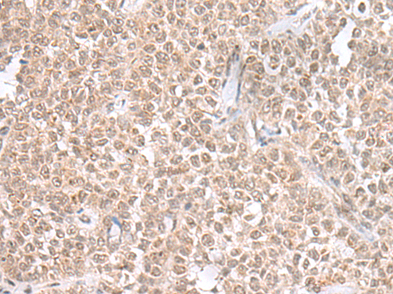 Immunohistochemistry of paraffin-embedded Human ovarian cancer tissue  using THAP12 Polyclonal Antibody at dilution of 1:45(×200)
