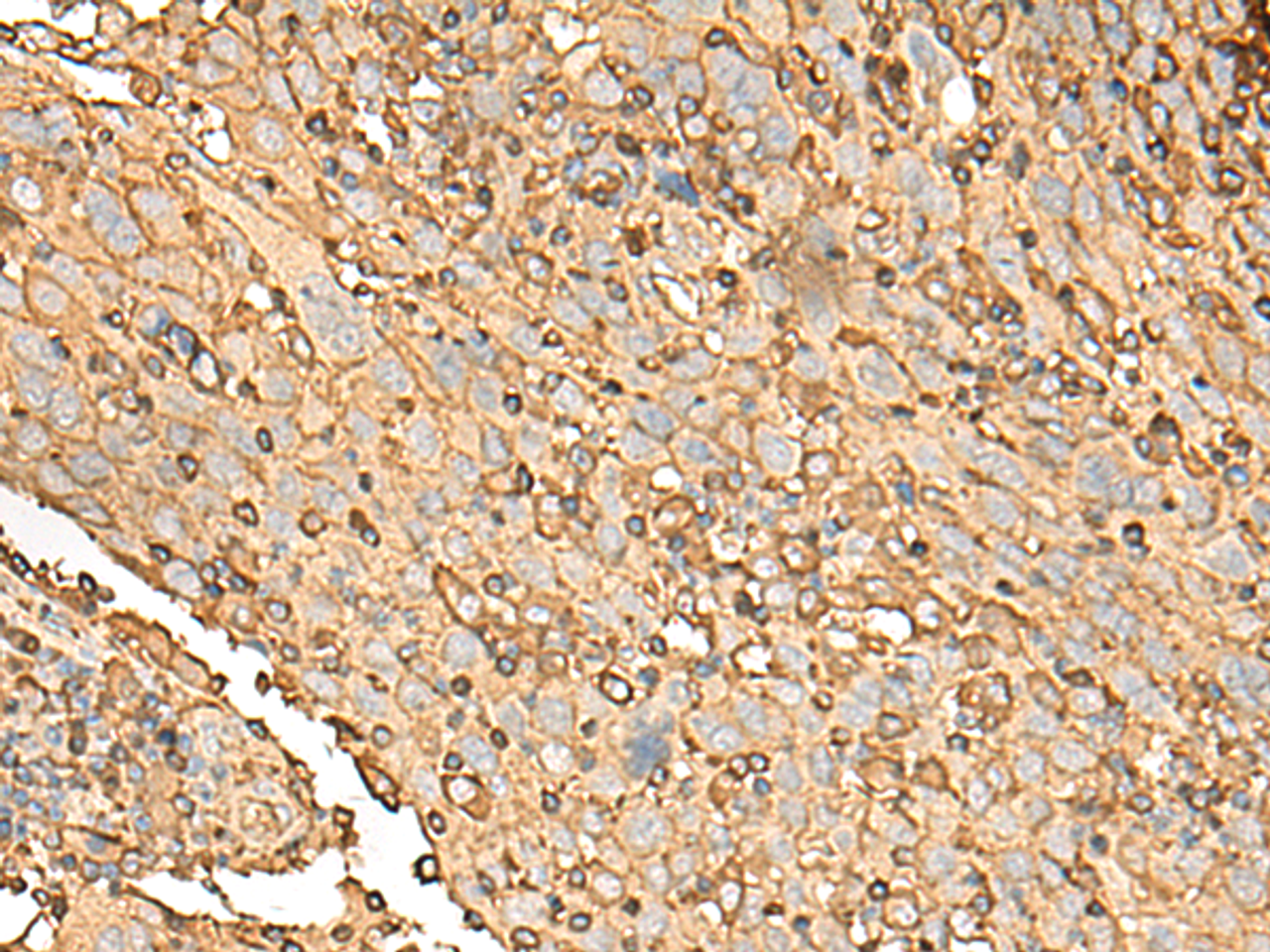 Immunohistochemistry of paraffin-embedded Human cervical cancer tissue  using UBE2A Polyclonal Antibody at dilution of 1:45(×200)