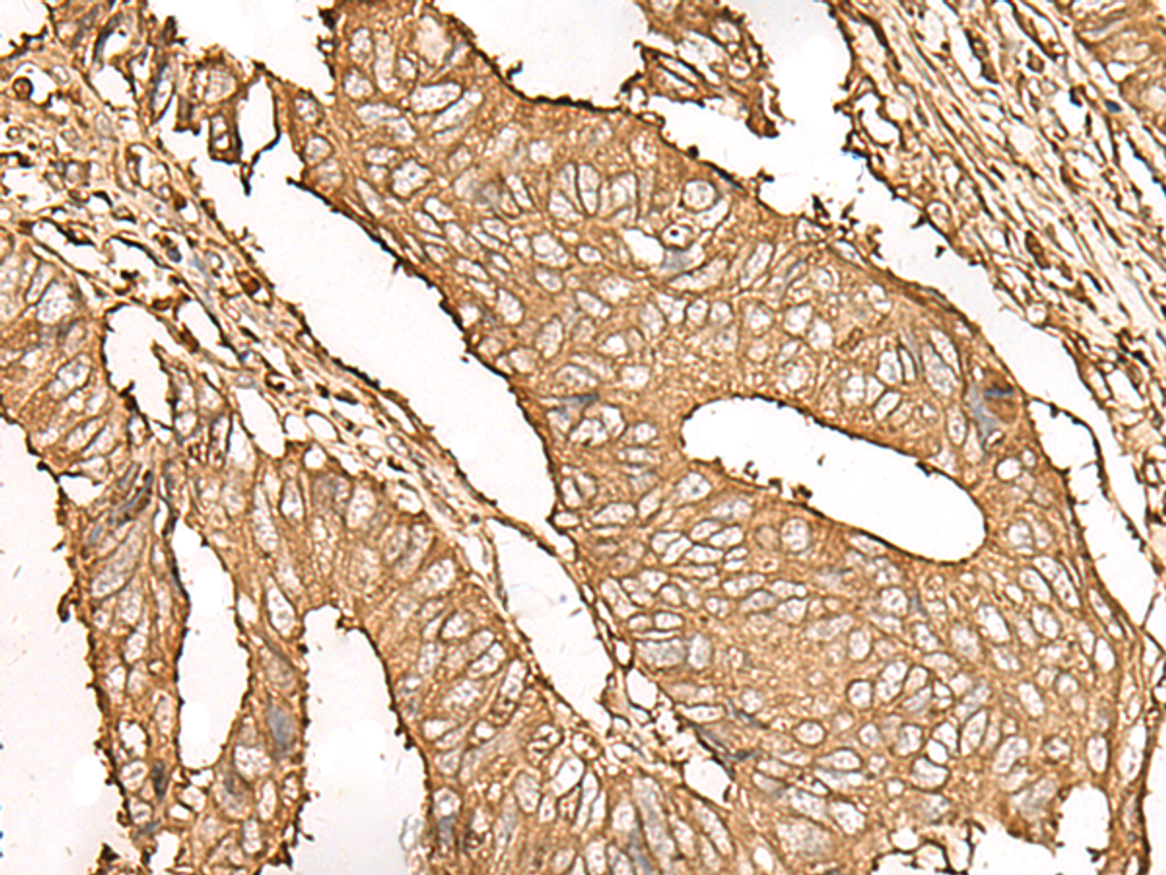 Immunohistochemistry of paraffin-embedded Human colorectal cancer tissue  using UBE2A Polyclonal Antibody at dilution of 1:45(×200)