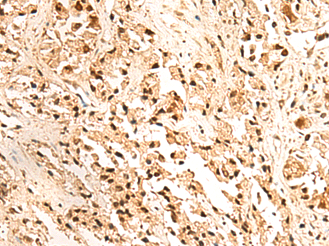 Immunohistochemistry of paraffin-embedded Human prost ate cancer tissue  using JPT2 Polyclonal Antibody at dilution of 1:65(×200)