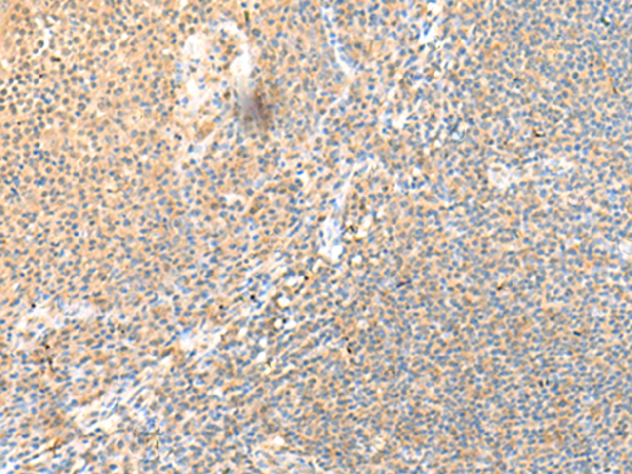 Immunohistochemistry of paraffin-embedded Human tonsil tissue  using SSC4D Polyclonal Antibody at dilution of 1:70(×200)