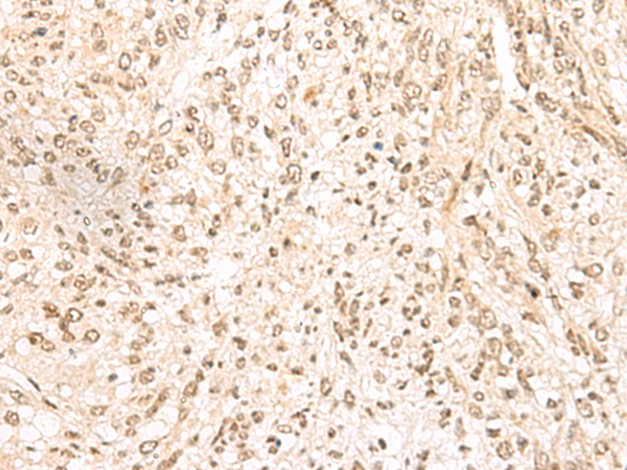 Immunohistochemistry of paraffin-embedded Human liver cancer tissue  using MDFI Polyclonal Antibody at dilution of 1:55(×200)