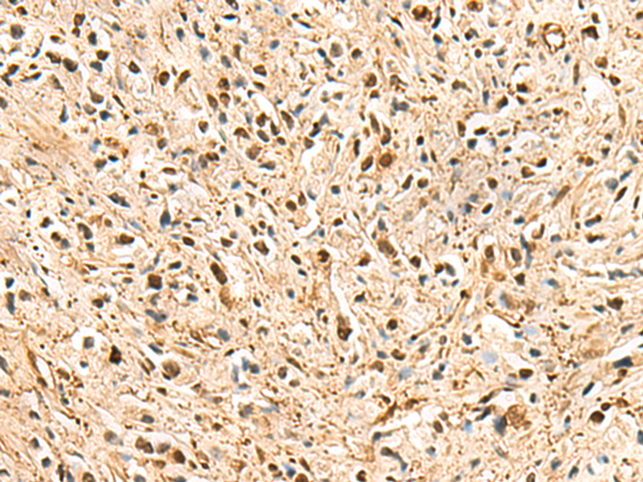 Immunohistochemistry of paraffin-embedded Human prost ate cancer tissue  using PSMA3 Polyclonal Antibody at dilution of 1:50(×200)