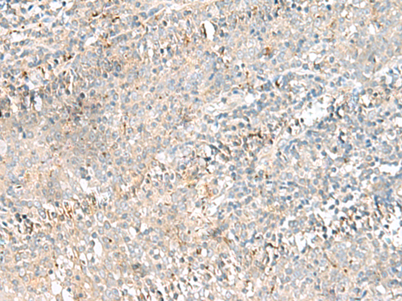 Immunohistochemistry of paraffin-embedded Human tonsil tissue  using CTRB1 Polyclonal Antibody at dilution of 1:55(×200)