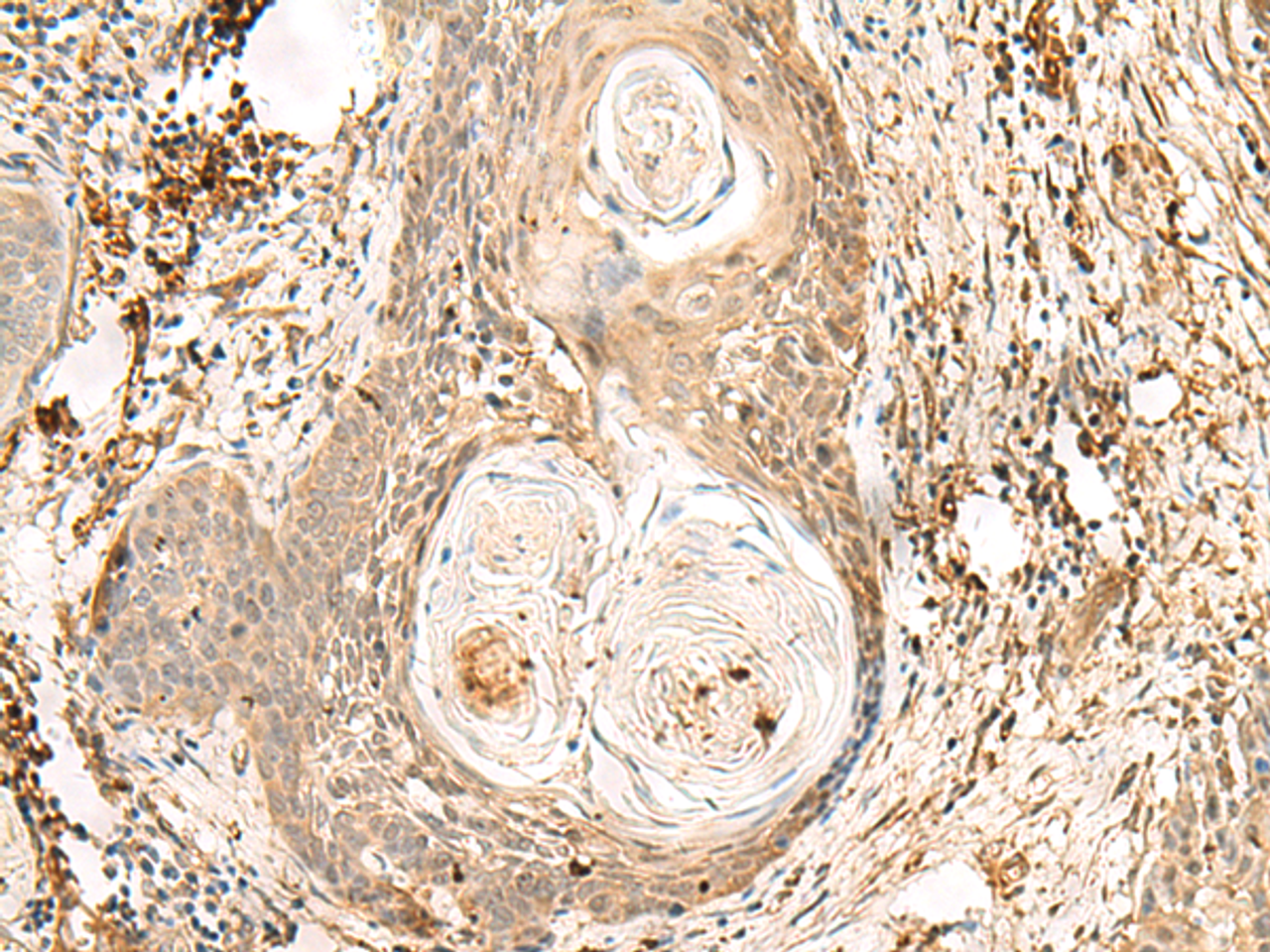 Immunohistochemistry of paraffin-embedded Human esophagus cancer tissue  using ZNF397 Polyclonal Antibody at dilution of 1:80(×200)