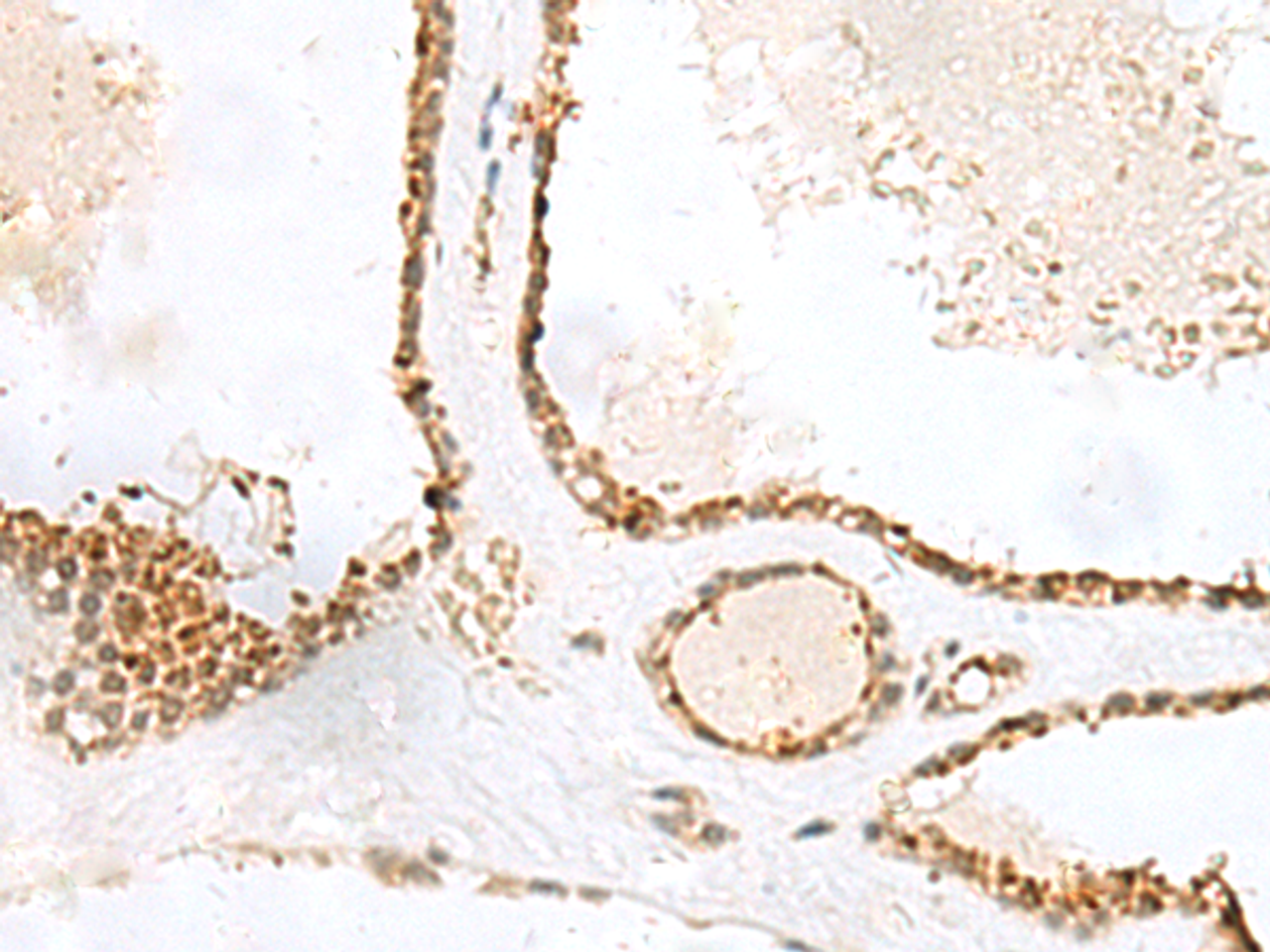 Immunohistochemistry of paraffin-embedded Human thyroid cancer tissue  using LPXN Polyclonal Antibody at dilution of 1:60(×200)