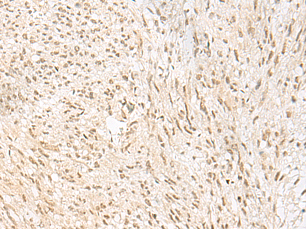 Immunohistochemistry of paraffin-embedded Human liver cancer tissue  using PSPC1 Polyclonal Antibody at dilution of 1:30(×200)