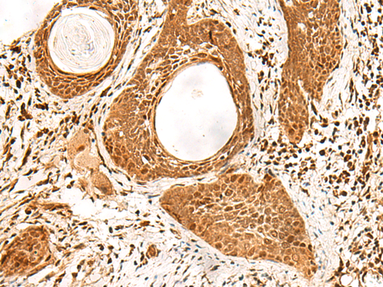 Immunohistochemistry of paraffin-embedded Human esophagus cancer tissue  using ADRM1 Polyclonal Antibody at dilution of 1:70(×200)