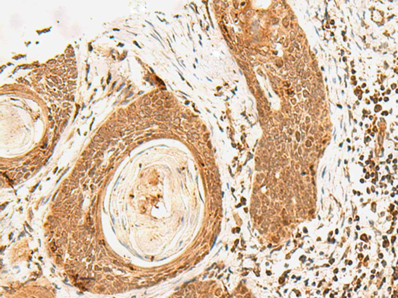 Immunohistochemistry of paraffin-embedded Human esophagus cancer tissue  using POLH Polyclonal Antibody at dilution of 1:60(×200)