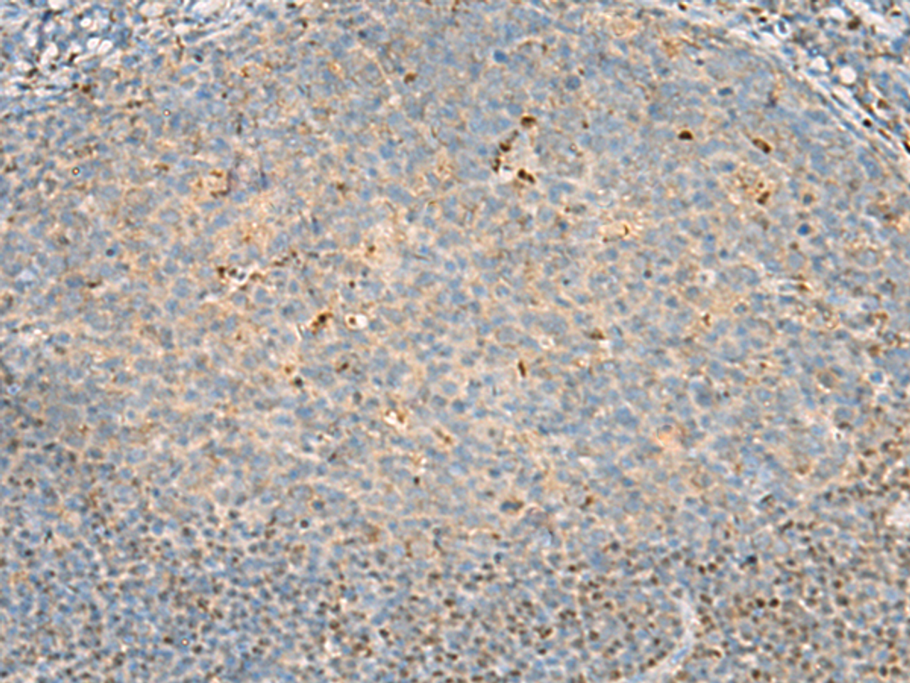 Immunohistochemistry of paraffin-embedded Human tonsil tissue  using DNPEP Polyclonal Antibody at dilution of 1:60(×200)