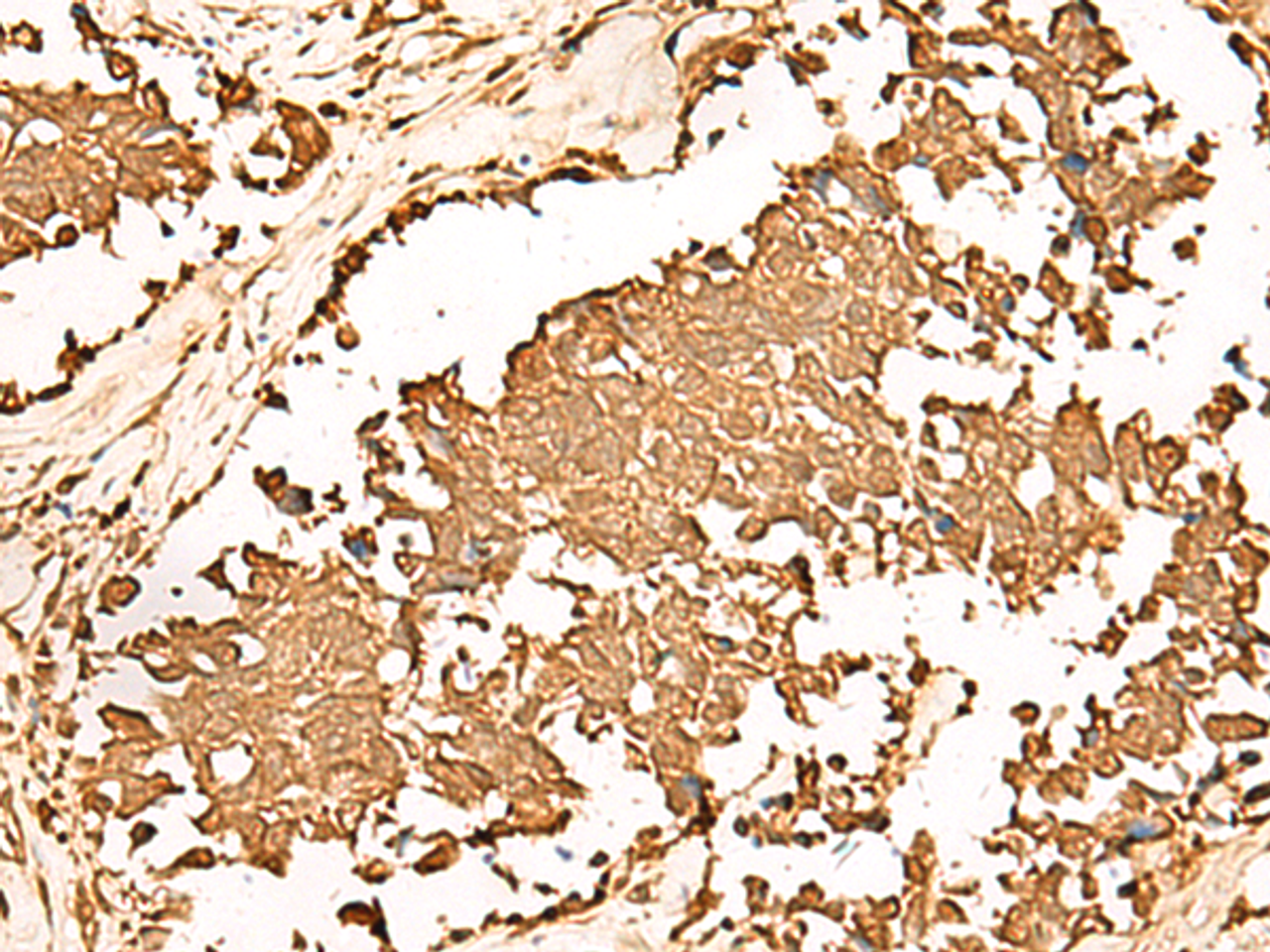 Immunohistochemistry of paraffin-embedded Human lung cancer tissue  using PWP1 Polyclonal Antibody at dilution of 1:70(×200)