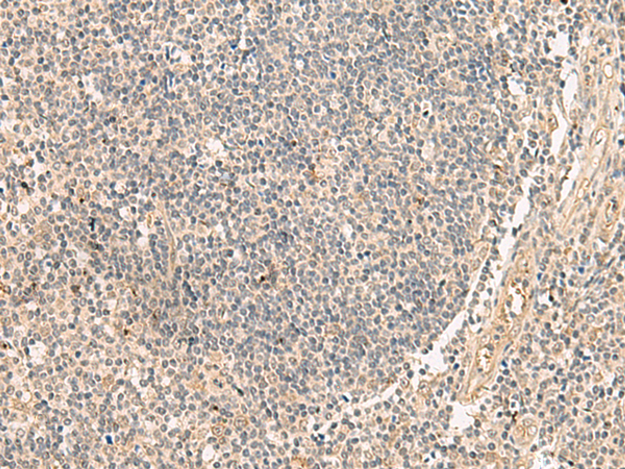 Immunohistochemistry of paraffin-embedded Human tonsil tissue  using PAF1 Polyclonal Antibody at dilution of 1:45(×200)