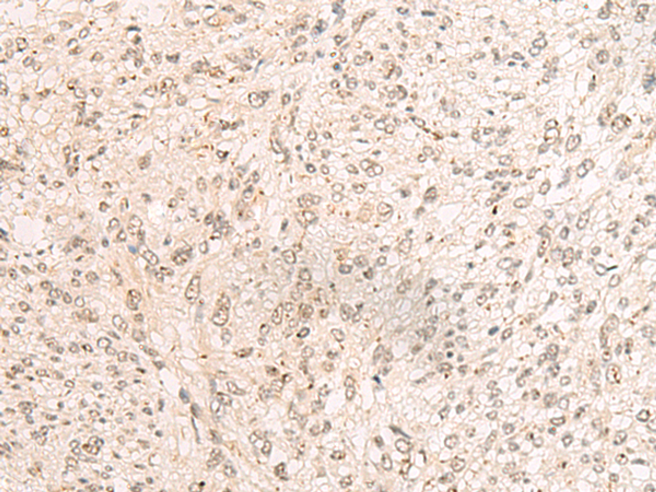 Immunohistochemistry of paraffin-embedded Human liver cancer tissue  using PAF1 Polyclonal Antibody at dilution of 1:45(×200)