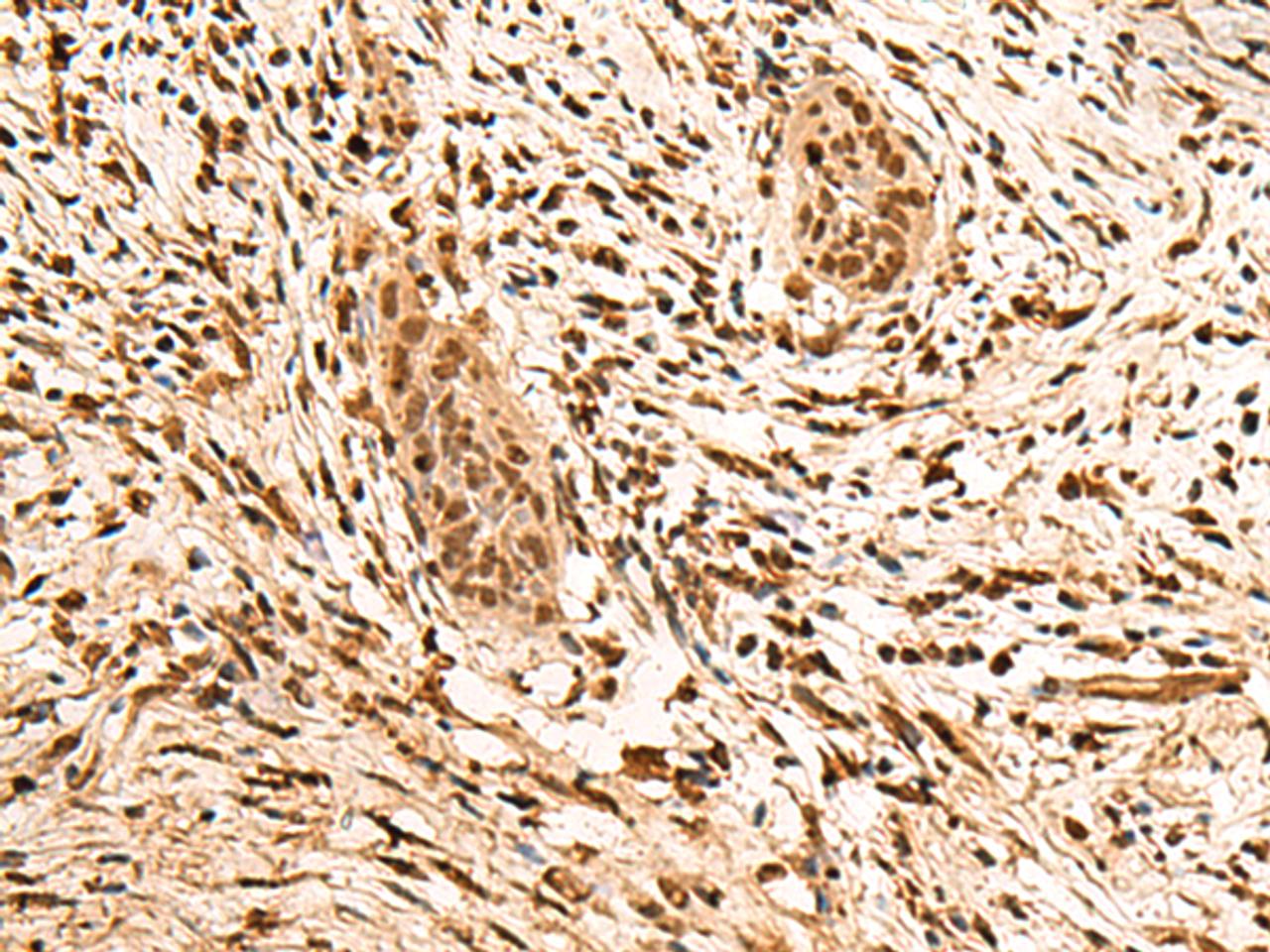 Immunohistochemistry of paraffin-embedded Human esophagus cancer tissue  using PPM1G Polyclonal Antibody at dilution of 1:40(×200)