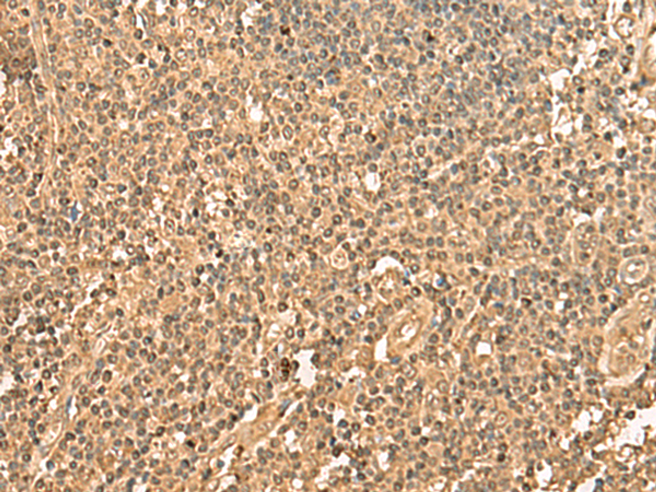 Immunohistochemistry of paraffin-embedded Human tonsil tissue  using PPM1G Polyclonal Antibody at dilution of 1:40(×200)