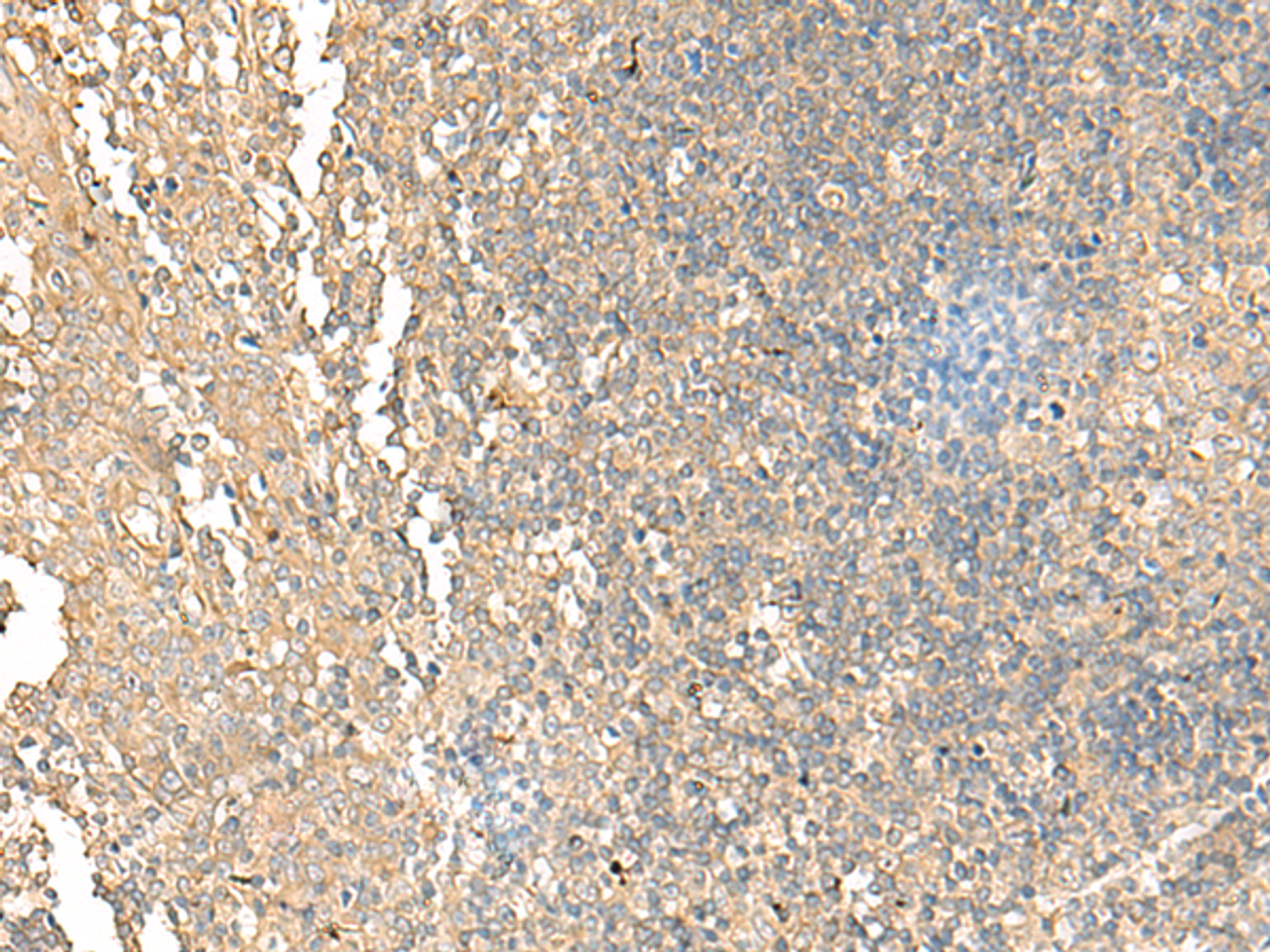Immunohistochemistry of paraffin-embedded Human tonsil tissue  using NARS Polyclonal Antibody at dilution of 1:55(×200)