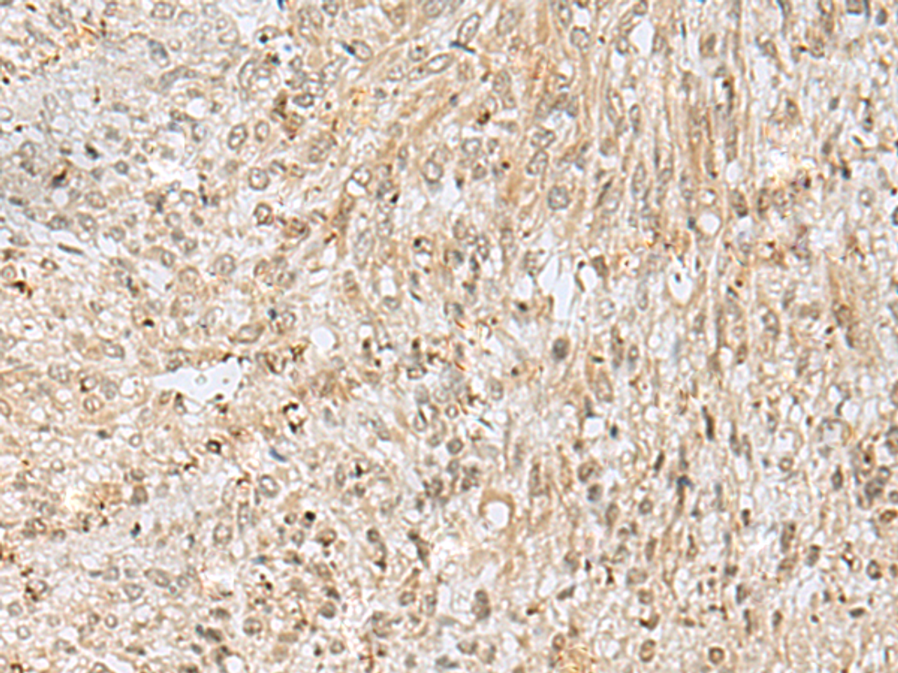 Immunohistochemistry of paraffin-embedded Human liver cancer tissue  using NUP58 Polyclonal Antibody at dilution of 1:50(×200)