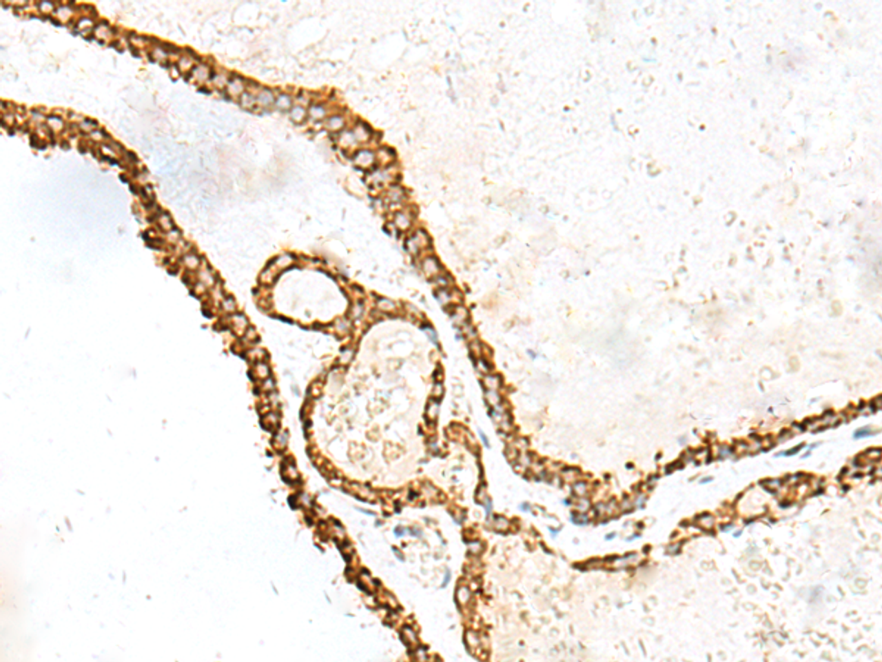 Immunohistochemistry of paraffin-embedded Human thyroid cancer tissue  using PDIA4 Polyclonal Antibody at dilution of 1:40(×200)