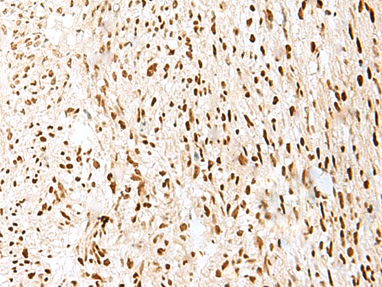 Immunohistochemistry of paraffin-embedded Human liver cancer tissue  using PRPF3 Polyclonal Antibody at dilution of 1:35(×200)