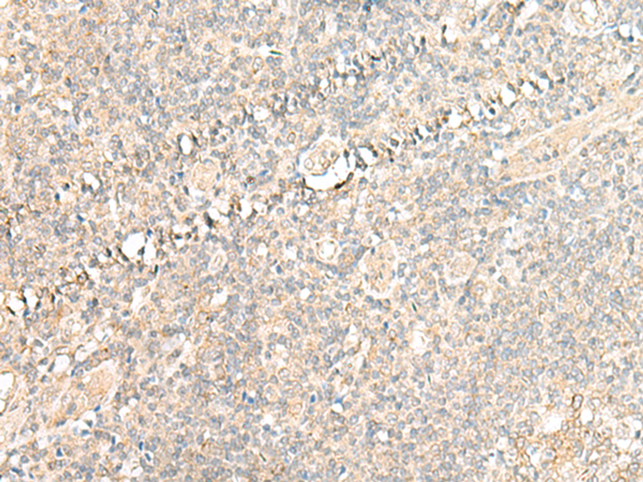 Immunohistochemistry of paraffin-embedded Human tonsil tissue  using CALCOCO1 Polyclonal Antibody at dilution of 1:50(×200)