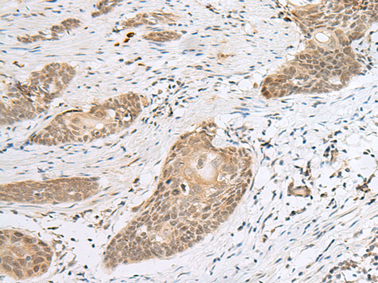 Immunohistochemistry of paraffin-embedded Human esophagus cancer tissue  using CALCOCO1 Polyclonal Antibody at dilution of 1:50(×200)