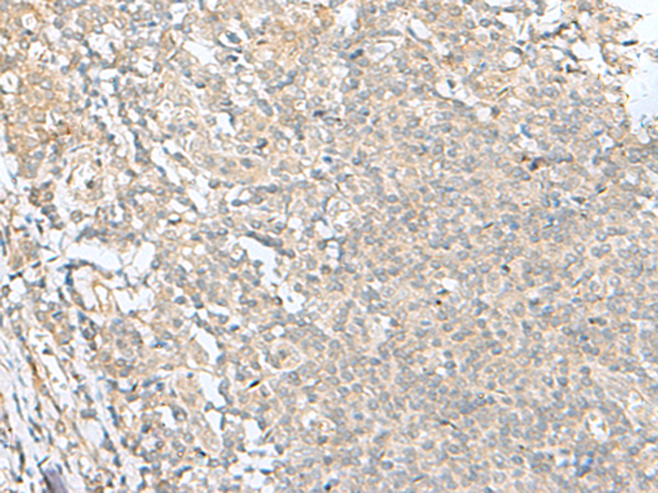 Immunohistochemistry of paraffin-embedded Human tonsil tissue  using SLC26A3 Polyclonal Antibody at dilution of 1:35(×200)