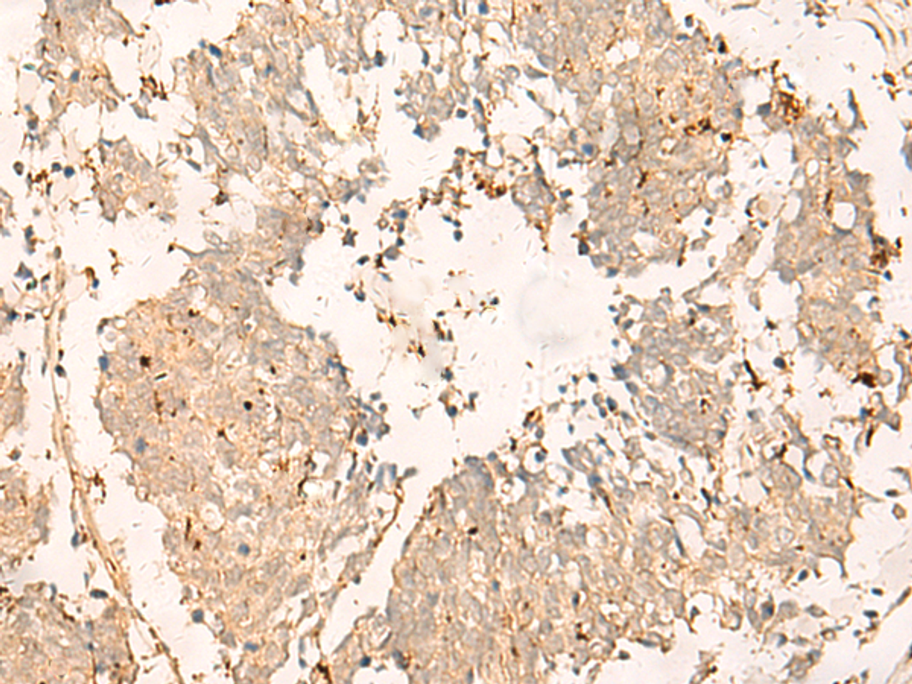 Immunohistochemistry of paraffin-embedded Human lung cancer tissue  using TEX11 Polyclonal Antibody at dilution of 1:30(×200)