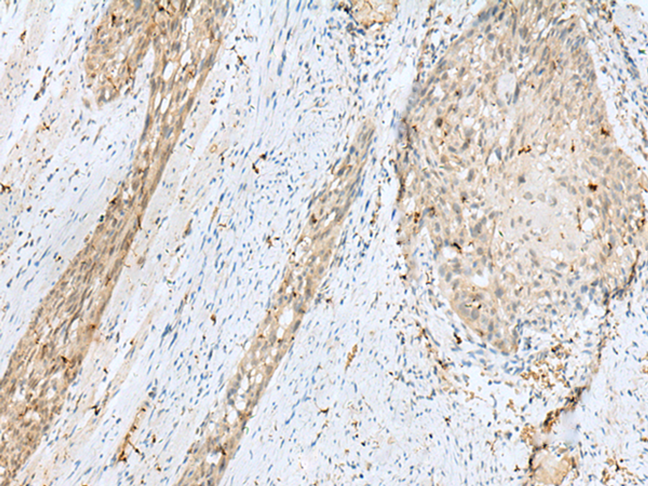 Immunohistochemistry of paraffin-embedded Human esophagus cancer tissue  using TEX11 Polyclonal Antibody at dilution of 1:30(×200)