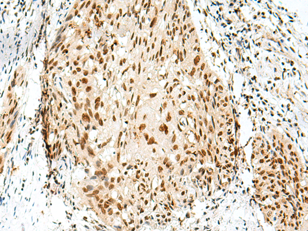 Immunohistochemistry of paraffin-embedded Human esophagus cancer tissue  using RBM10 Polyclonal Antibody at dilution of 1:55(×200)