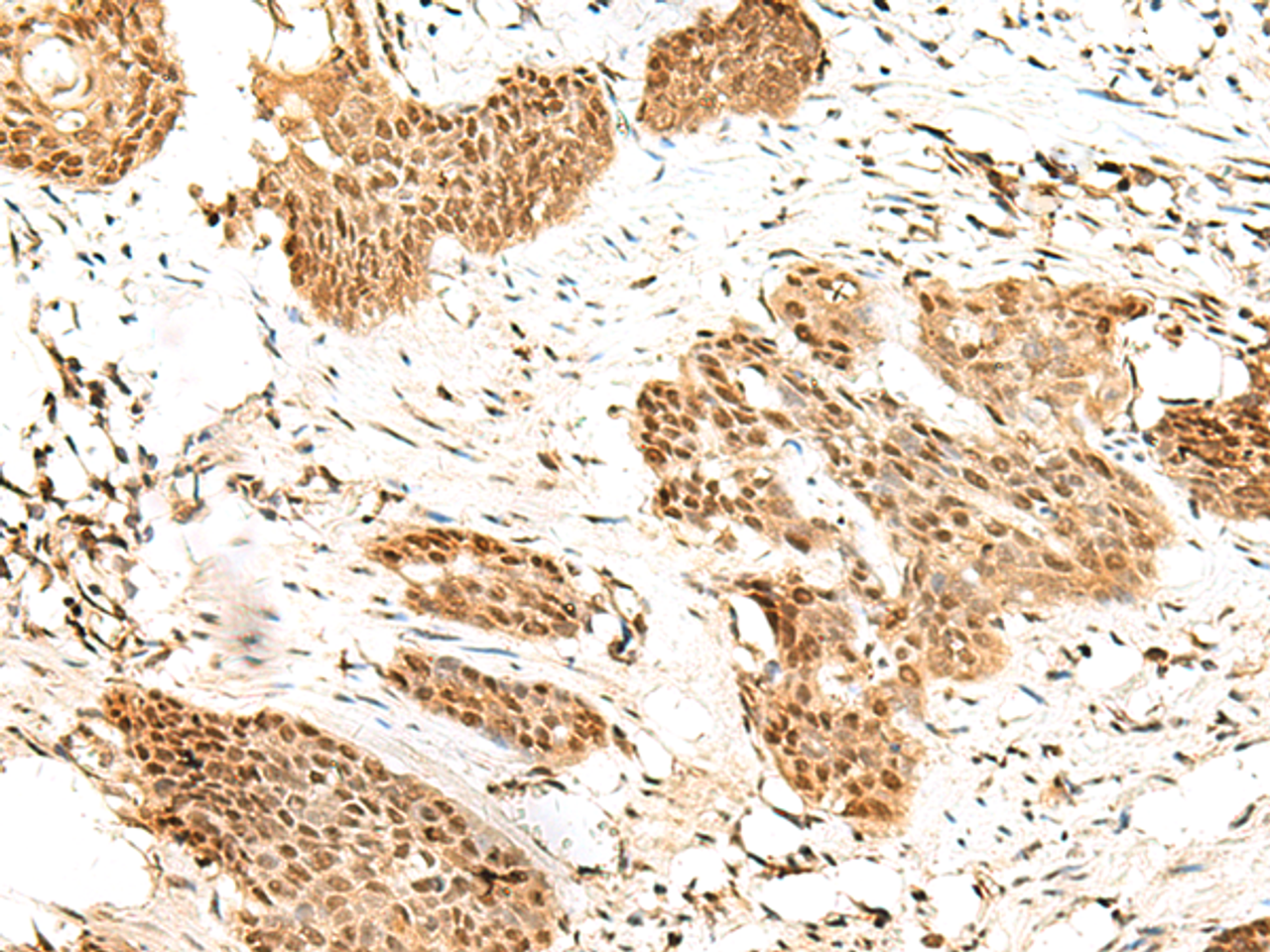 Immunohistochemistry of paraffin-embedded Human esophagus cancer tissue  using RBM19 Polyclonal Antibody at dilution of 1:45(×200)