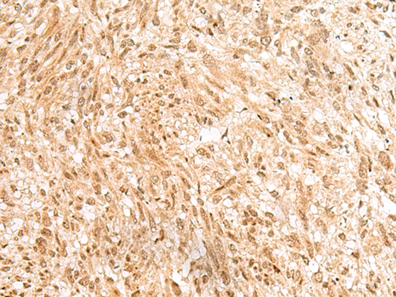 Immunohistochemistry of paraffin-embedded Human liver cancer tissue  using RBM19 Polyclonal Antibody at dilution of 1:45(×200)