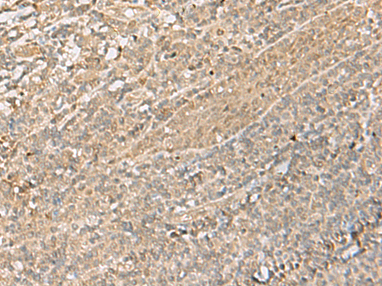 Immunohistochemistry of paraffin-embedded Human tonsil tissue  using IPO11 Polyclonal Antibody at dilution of 1:70(×200)