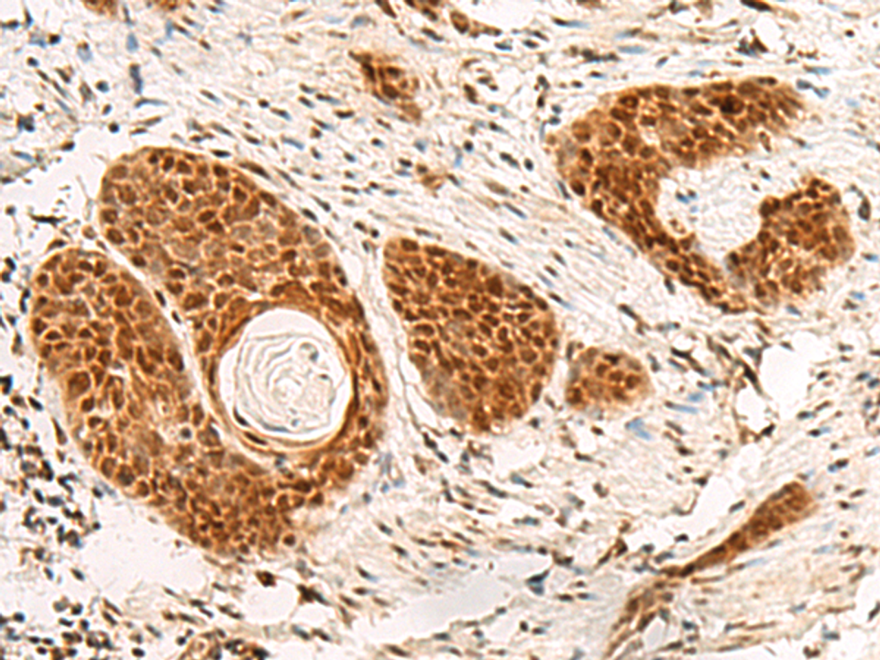 Immunohistochemistry of paraffin-embedded Human esophagus cancer tissue  using POM121 Polyclonal Antibody at dilution of 1:75(×200)