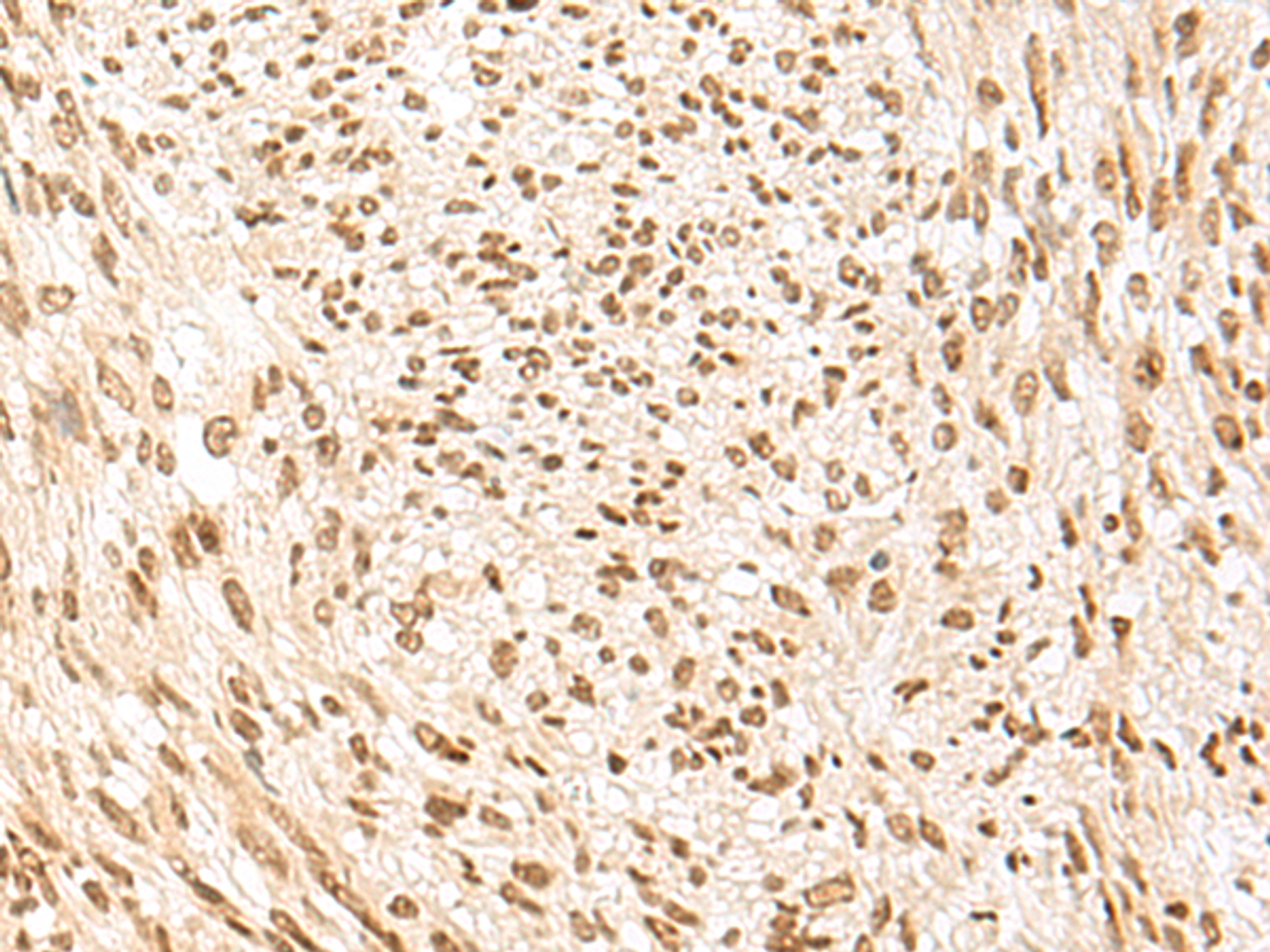 Immunohistochemistry of paraffin-embedded Human liver cancer tissue  using POM121 Polyclonal Antibody at dilution of 1:75(×200)