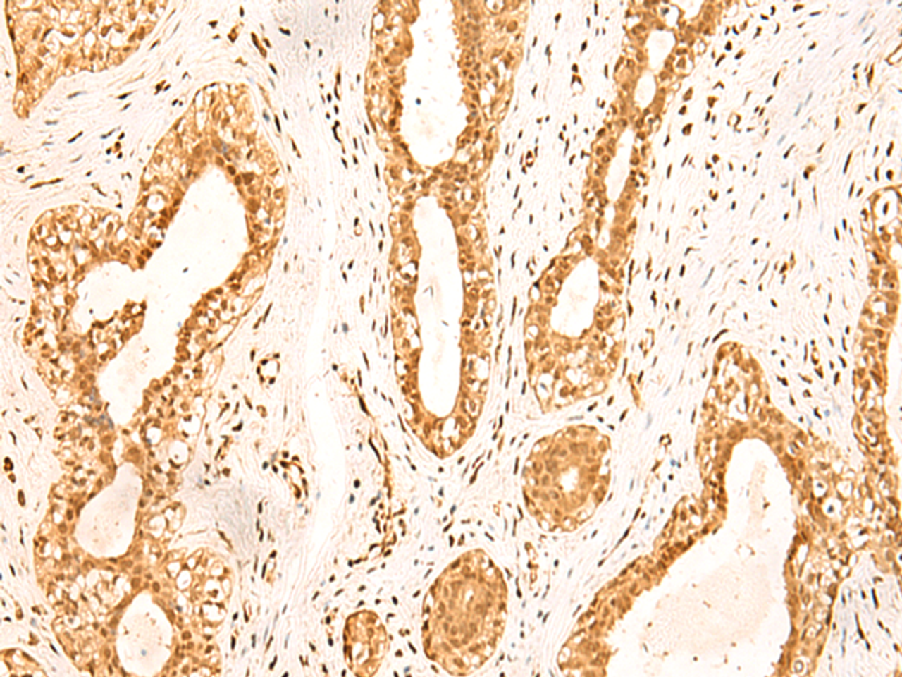 Immunohistochemistry of paraffin-embedded Human breast cancer tissue  using ZNF471 Polyclonal Antibody at dilution of 1:50(×200)