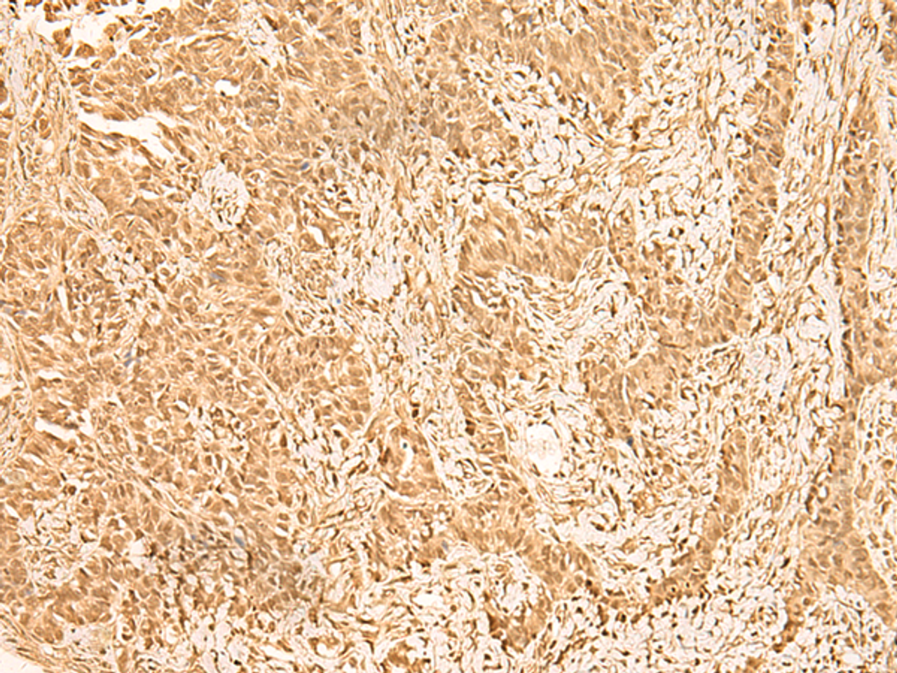 Immunohistochemistry of paraffin-embedded Human ovarian cancer tissue  using ZNF471 Polyclonal Antibody at dilution of 1:50(×200)