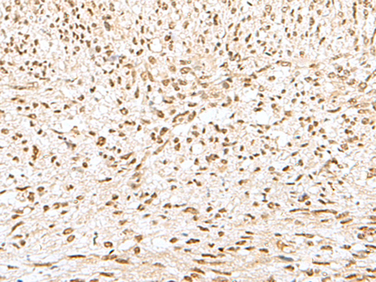 Immunohistochemistry of paraffin-embedded Human liver cancer tissue  using GTF2A2 Polyclonal Antibody at dilution of 1:30(×200)