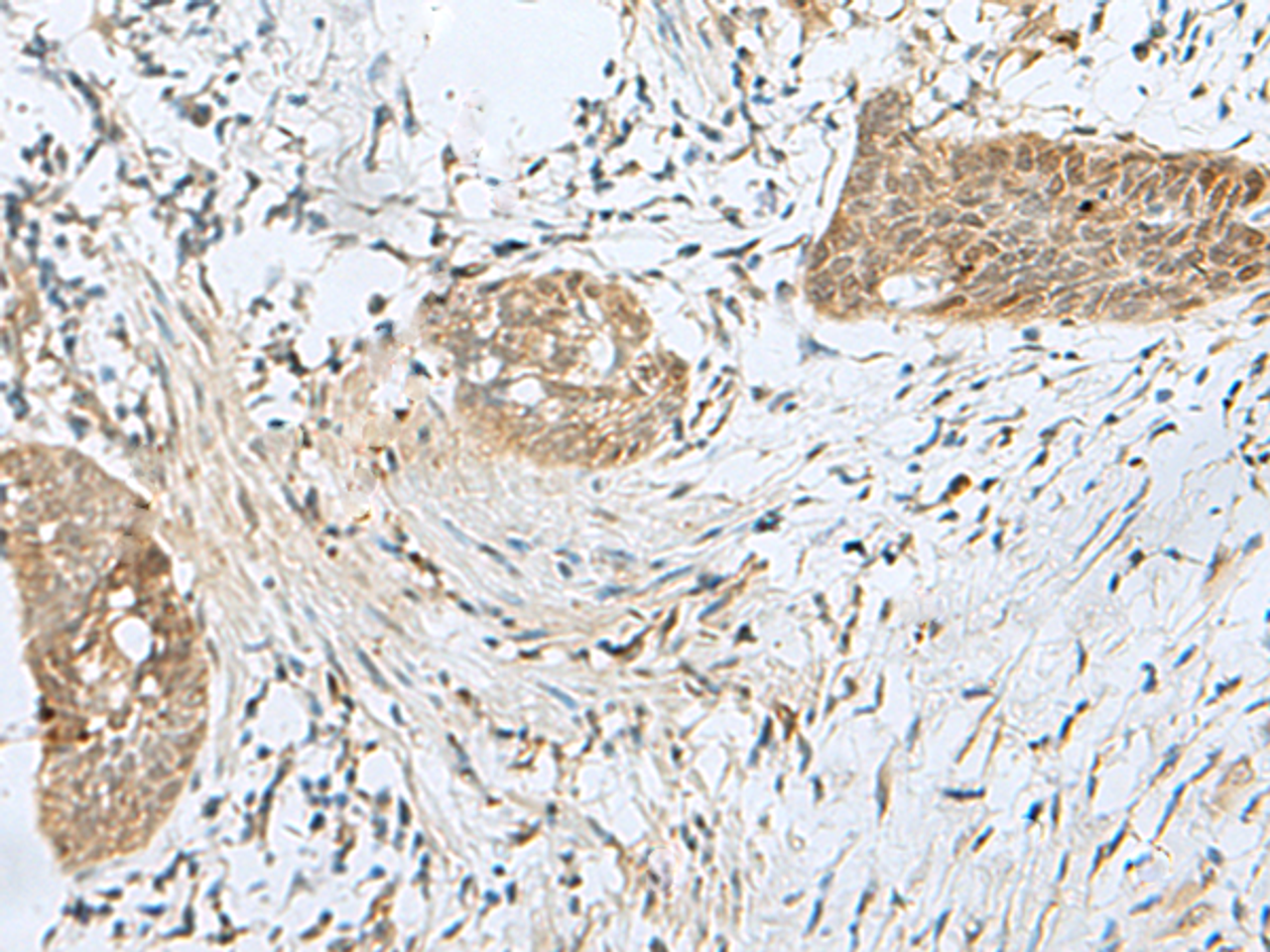 Immunohistochemistry of paraffin-embedded Human esophagus cancer tissue  using SNRPD1 Polyclonal Antibody at dilution of 1:70(×200)