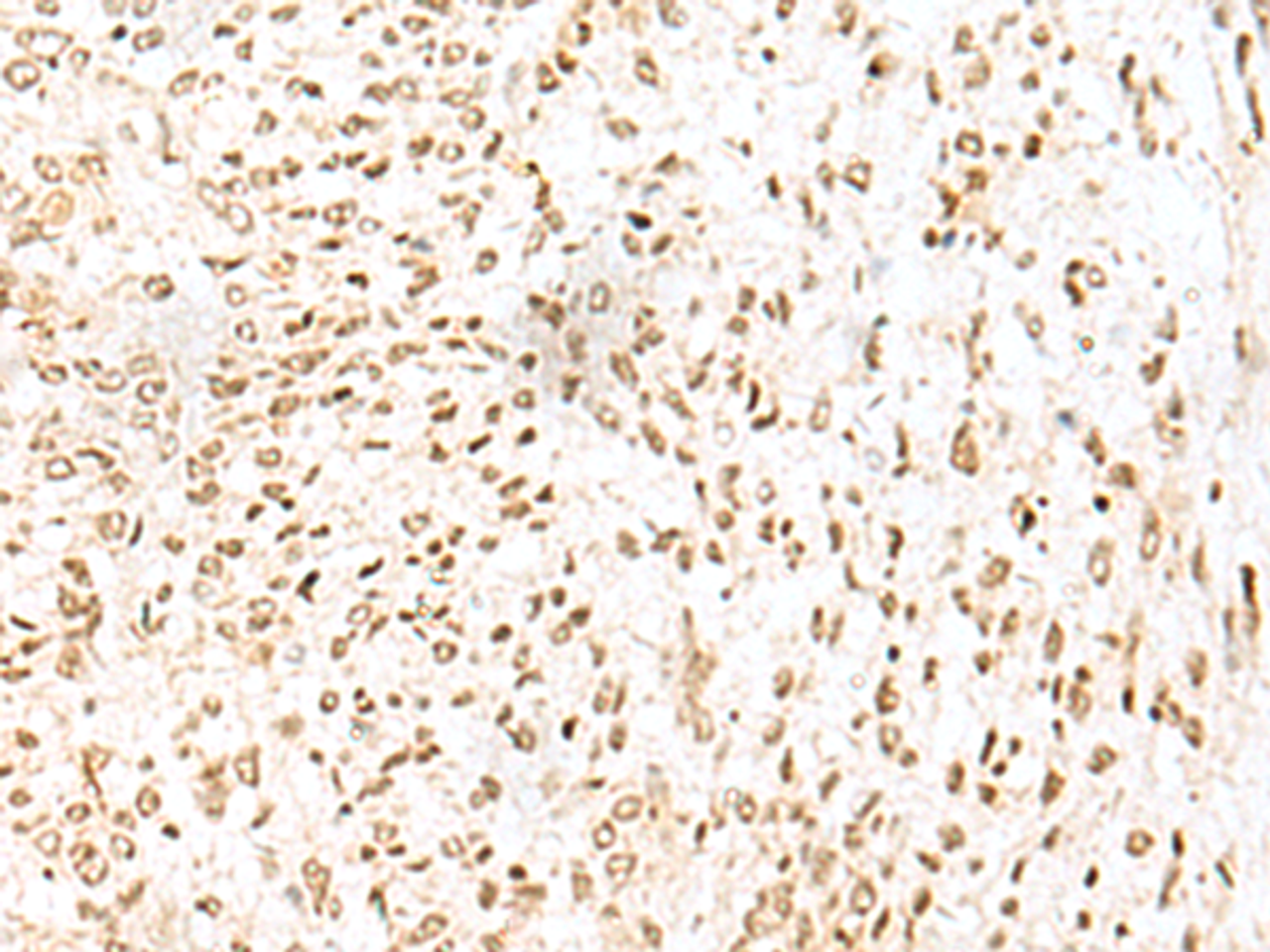 Immunohistochemistry of paraffin-embedded Human liver cancer tissue  using LYRM1 Polyclonal Antibody at dilution of 1:50(×200)