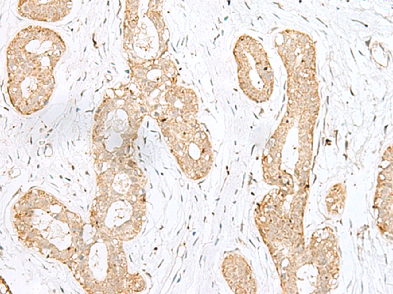 Immunohistochemistry of paraffin-embedded Human breast cancer tissue  using BEX2 Polyclonal Antibody at dilution of 1:45(×200)