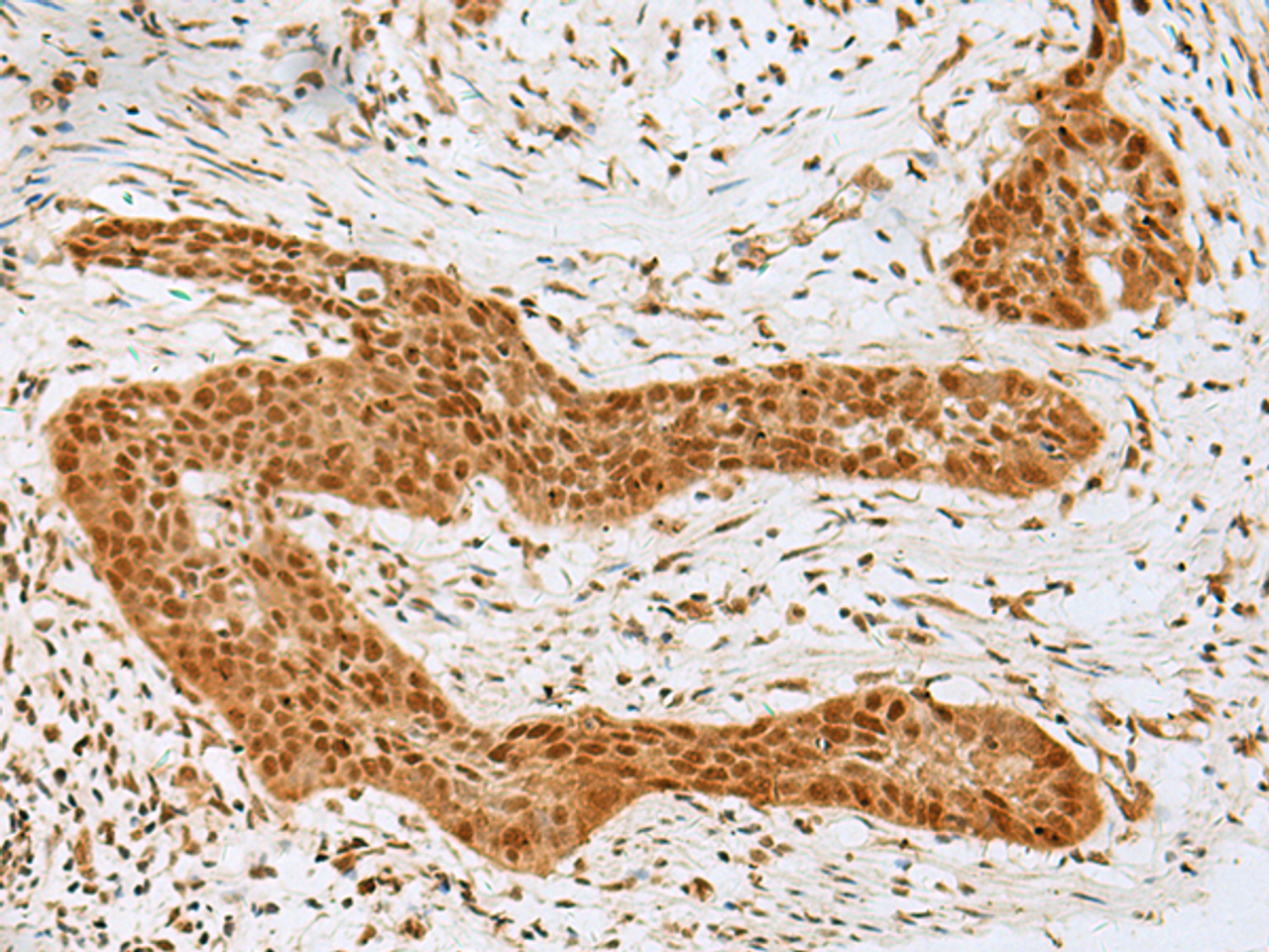 Immunohistochemistry of paraffin-embedded Human esophagus cancer tissue  using GOLGA7 Polyclonal Antibody at dilution of 1:40(×200)