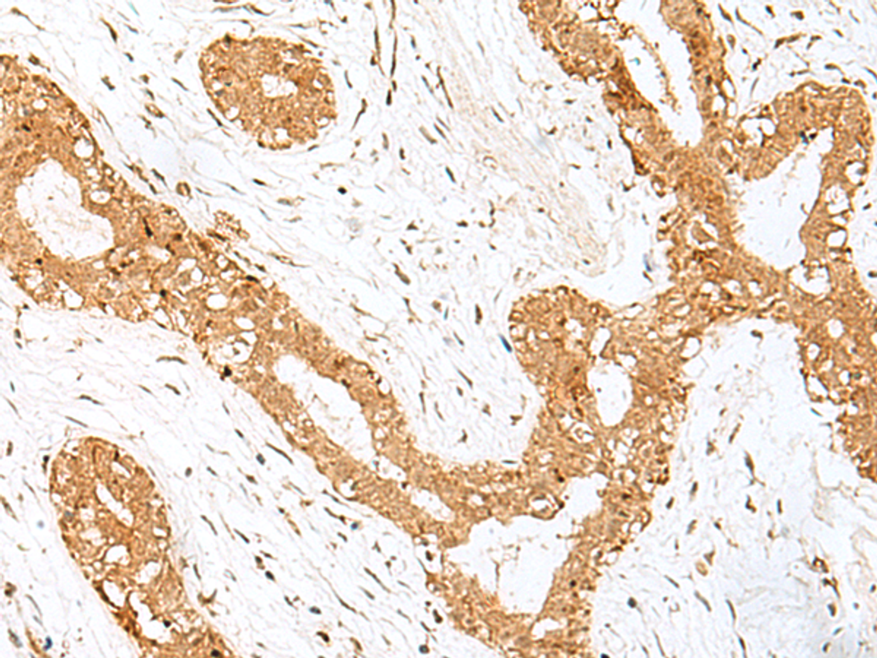 Immunohistochemistry of paraffin-embedded Human breast cancer tissue  using GOLGA7 Polyclonal Antibody at dilution of 1:40(×200)