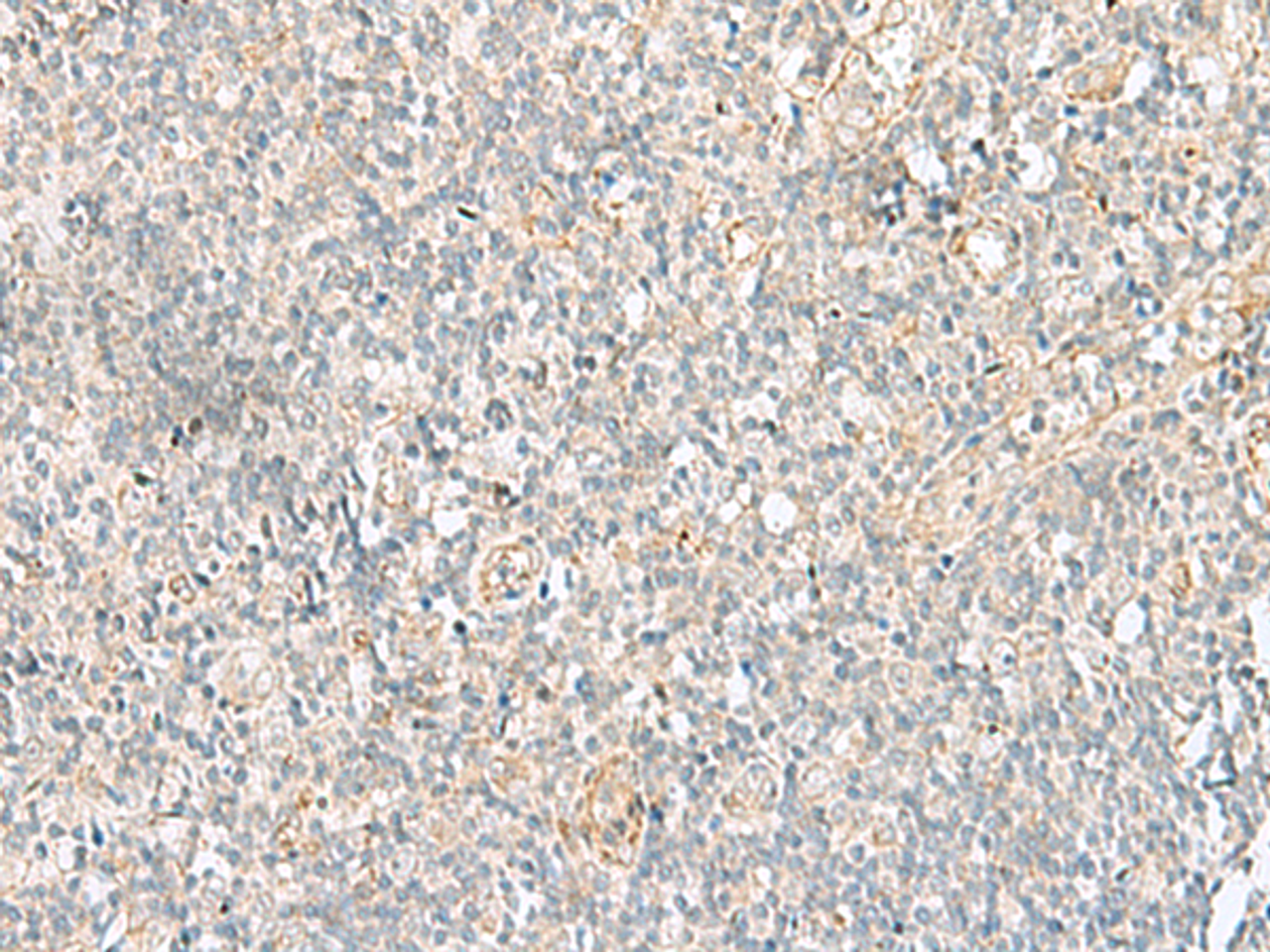 Immunohistochemistry of paraffin-embedded Human tonsil tissue  using GSKIP Polyclonal Antibody at dilution of 1:55(×200)