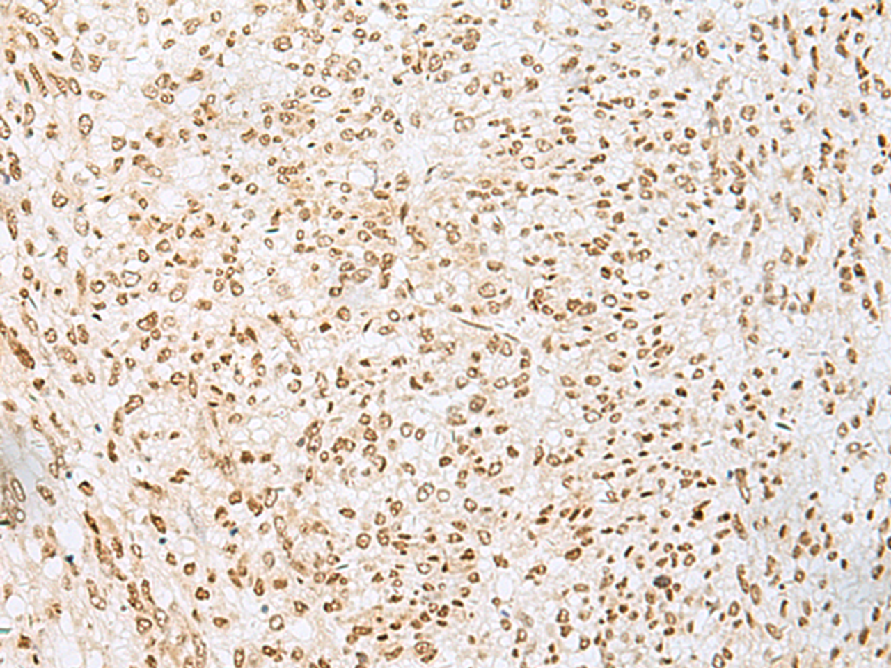 Immunohistochemistry of paraffin-embedded Human liver cancer tissue  using PNRC2 Polyclonal Antibody at dilution of 1:30(×200)