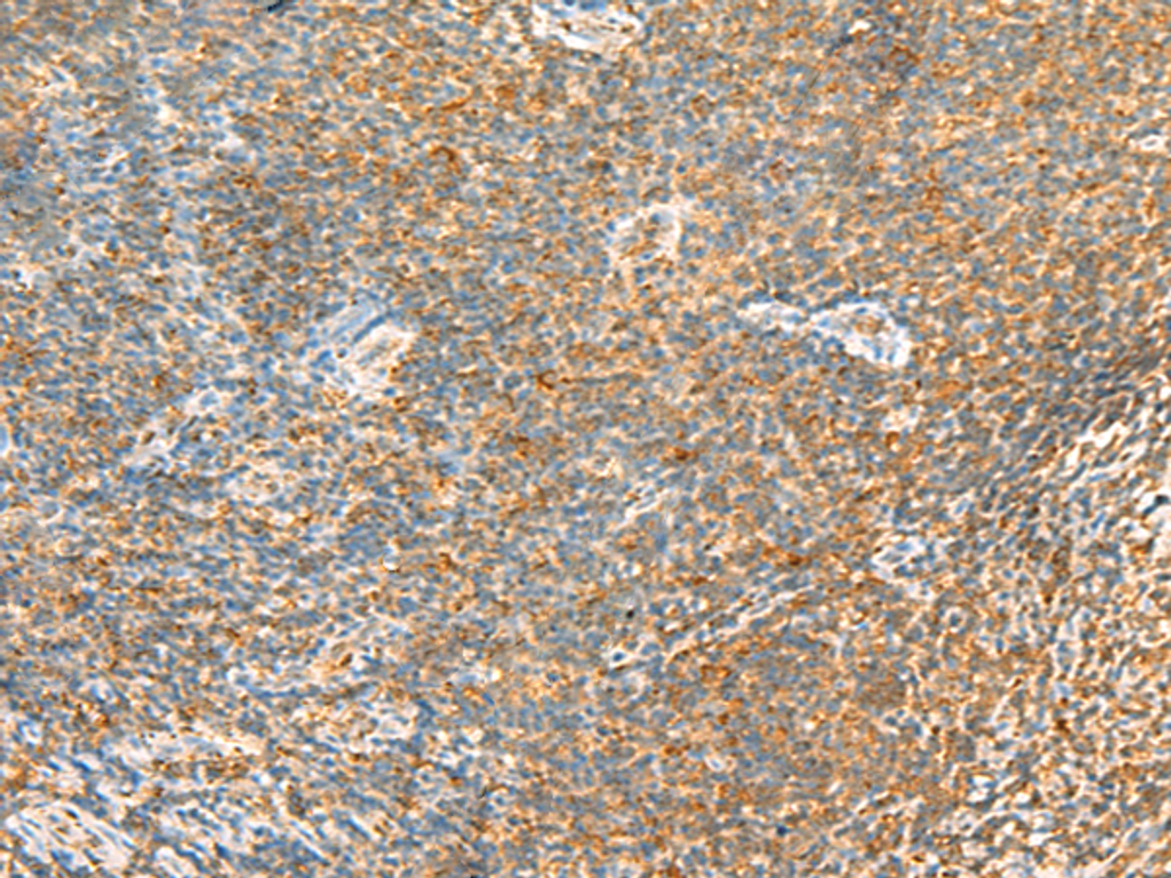 Immunohistochemistry of paraffin-embedded Human tonsil tissue  using MTHFD2L Polyclonal Antibody at dilution of 1:30(×200)