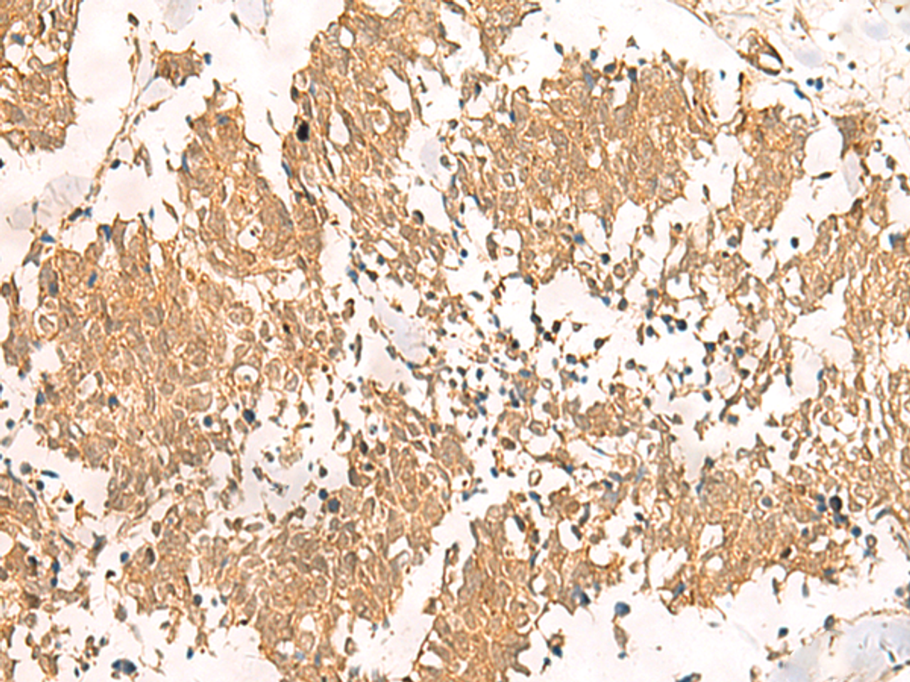 Immunohistochemistry of paraffin-embedded Human lung cancer tissue  using MTHFD2L Polyclonal Antibody at dilution of 1:30(×200)
